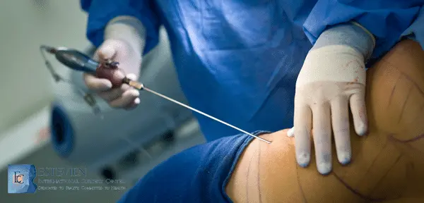 Vaser Liposuction Ameliyatı Fiyatları 2024