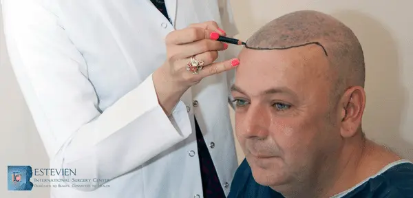 Hair Transplant Turkey Cost 2024 Packages