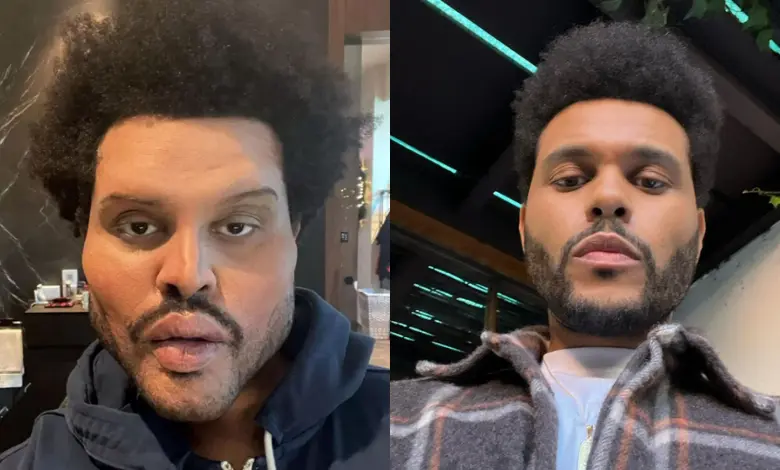 The Weeknd Plastic Surgery Before and After