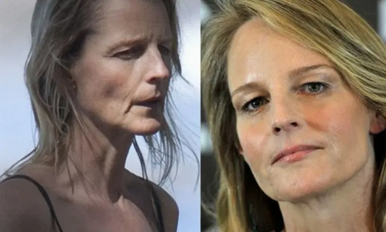 Helen Hunt Plastic Surgery Journey Truth or Speculation