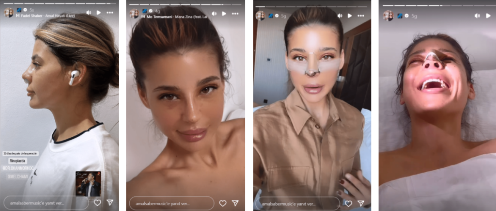 AMAL SABER’s Rhinoplasty Turkey Before and After