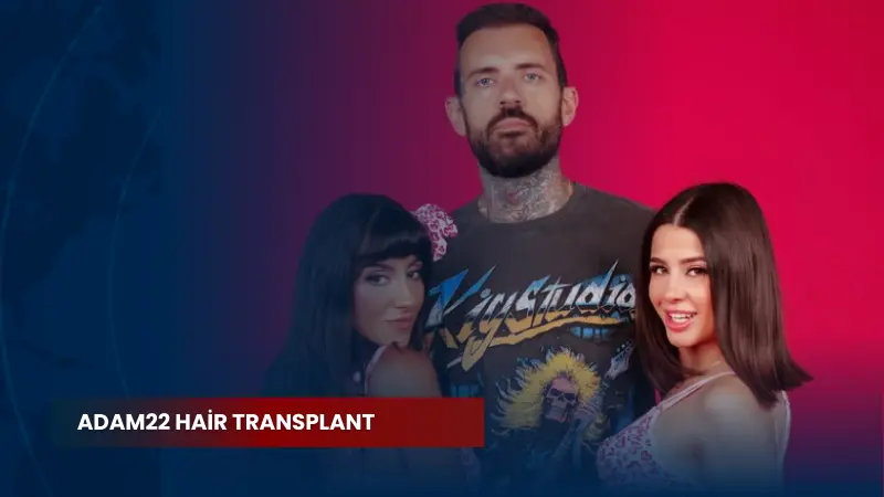 Adam22 Hair Transplant