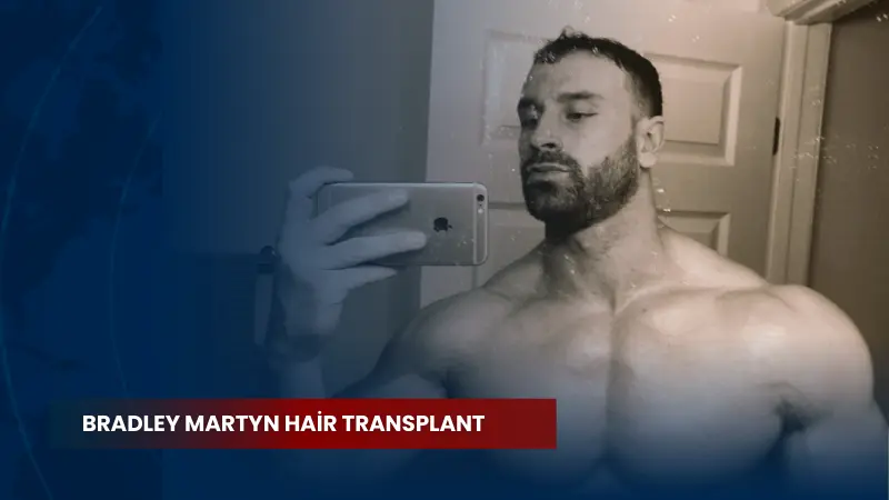 Bradley Martyn Hair Transplant