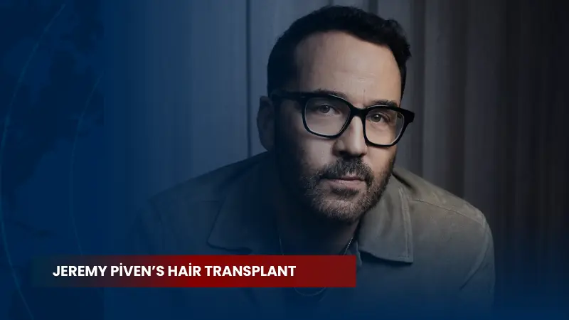 Jeremy Piven’s Hair Transplant